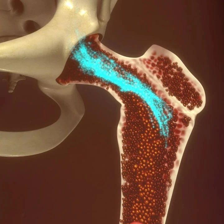 AJH丨梅奥经验：脾切除术在JAK2抑制剂治疗的骨髓纤维化患者中的结果'